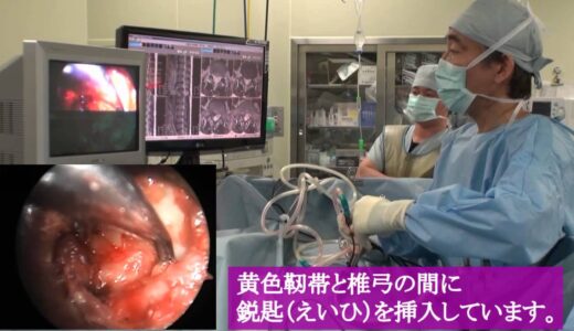 頚椎椎間板ヘルニア手術前の情報収集