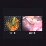 腹腔鏡下手術の進化　胃がんが治せる！