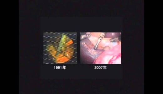 腹腔鏡下手術の進化　胃がんが治せる！