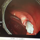 がんを宣告された患者の心理