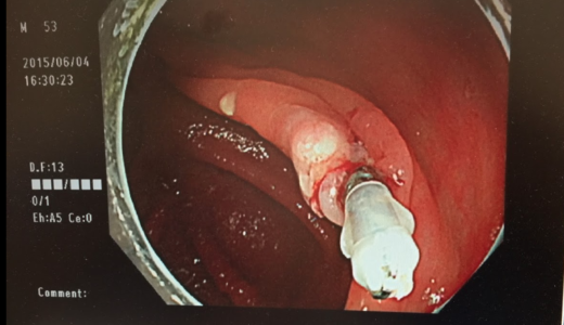 がんを宣告された患者の心理