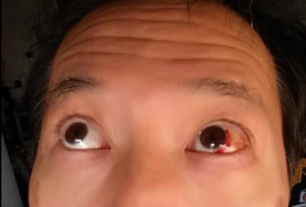 結膜下出血（けつまくかしゅっけつ）3日目