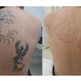 タトゥーを消すのは医師「死ぬぐらいの痛み覚悟して」 