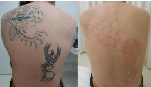 タトゥーを消すのは医師「死ぬぐらいの痛み覚悟して」 